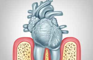 Gum Diseases