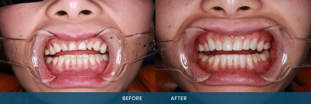 Porcelain Dental Veneers