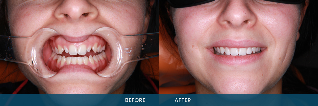 Porcelain Veneers Melbourne