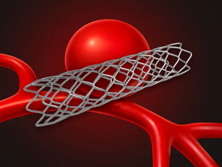 Coiling Aneurysm Surgery